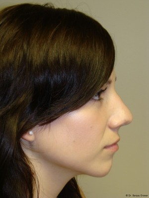 Rhinoplasty Before and After 32 | Sanjay Grover MD FACS