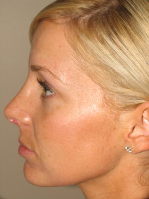 Rhinoplasty Before and After 14 | Sanjay Grover MD FACS