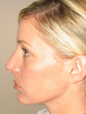 Rhinoplasty Before and After 15 | Sanjay Grover MD FACS