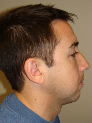 Rhinoplasty Before and After 23 | Sanjay Grover MD FACS