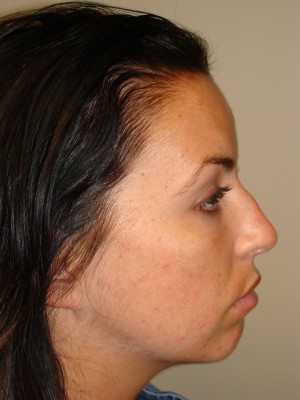 Rhinoplasty Before and After 10 | Sanjay Grover MD FACS
