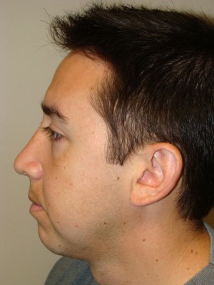 Rhinoplasty Before and After 19 | Sanjay Grover MD FACS