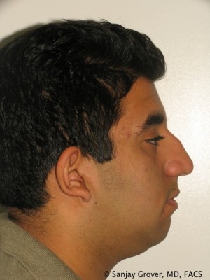 Rhinoplasty Before and After 45 | Sanjay Grover MD FACS