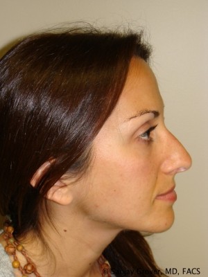 Rhinoplasty Before and After 37 | Sanjay Grover MD FACS