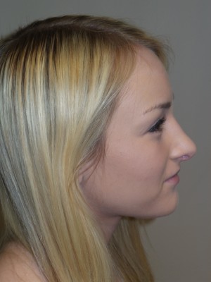 Rhinoplasty Before and After 27 | Sanjay Grover MD FACS