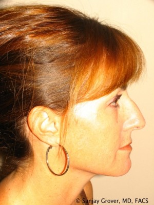 Rhinoplasty Before and After 14 | Sanjay Grover MD FACS
