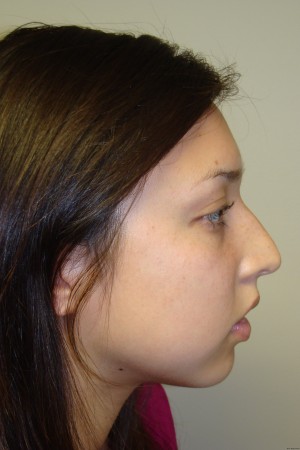 Rhinoplasty Before and After 39 | Sanjay Grover MD FACS