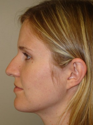 Rhinoplasty Before and After 45 | Sanjay Grover MD FACS