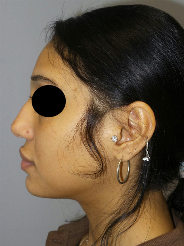 Rhinoplasty Before and After 46 | Sanjay Grover MD FACS