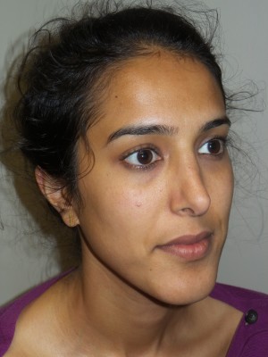 Rhinoplasty Before and After 46 | Sanjay Grover MD FACS