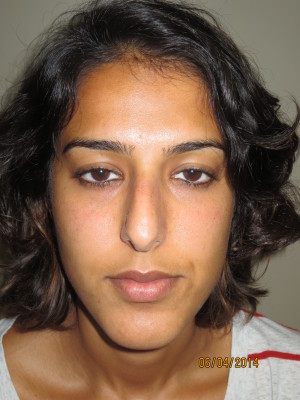 Rhinoplasty Before and After 46 | Sanjay Grover MD FACS