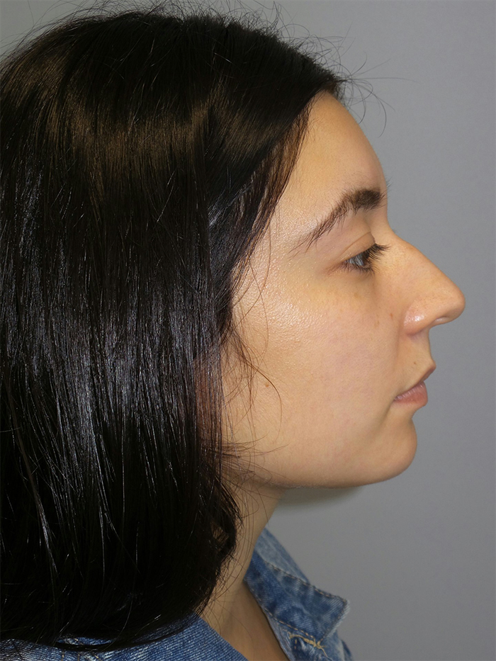 Rhinoplasty Before and After 46 | Sanjay Grover MD FACS