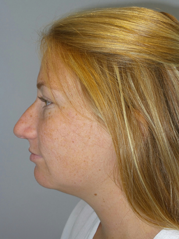 Rhinoplasty Before and After 49 | Sanjay Grover MD FACS