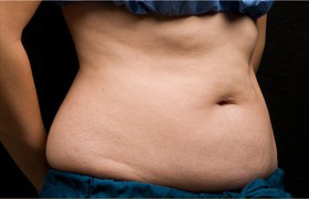 Coolsculpting Before and After 01 | Sanjay Grover MD FACS