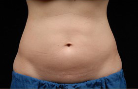 Coolsculpting Before and After 09 | Sanjay Grover MD FACS