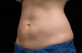 Coolsculpting Before and After 08 | Sanjay Grover MD FACS