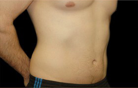 Coolsculpting Before and After | Sanjay Grover MD FACS