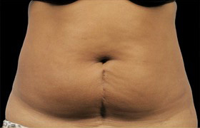 Coolsculpting Before and After 18 | Sanjay Grover MD FACS