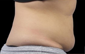 Coolsculpting Before and After 19 | Sanjay Grover MD FACS