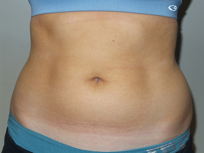 Emsculpt Before and After 02 | Sanjay Grover MD FACS
